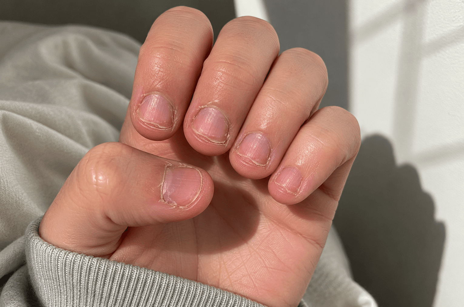 Nagelbeißer Behandlung im Kosmetiksalon Kleopatra Wien